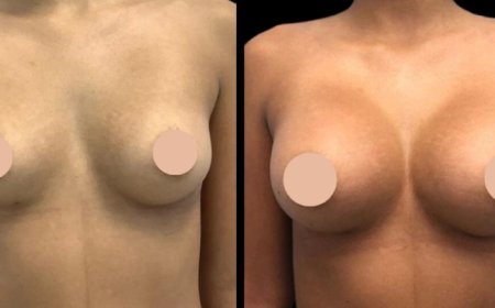 Meet the Best Breast Augmentation Surgeons in Dubai