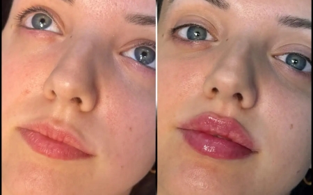 Best Aesthetic Clinic in dubai for Fillers: How to Maintain Your Look