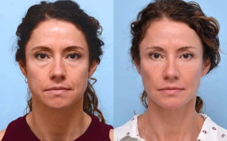 Best Plastic Surgeons in Dubai: Understanding the Different Types of Threads Used for Thread Lifts