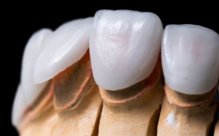 Veneers Explained: How They Can Instantly Upgrade Your Smile