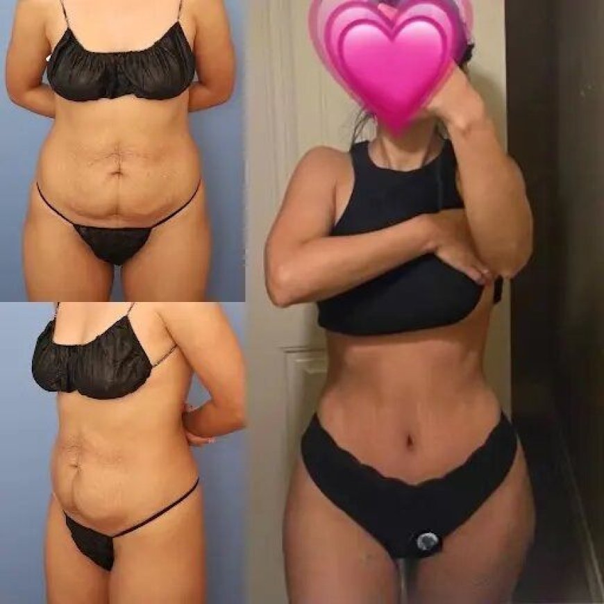 Tummy Tuck in Dubai: Achieving the Best Results from Your Procedure