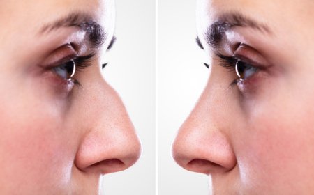 Rhinoplasty in Dubai: Everything You Need to Know Before Your Surgery