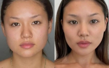 Buccal fat removal Surgery in Dubai and Skincare After Surgery