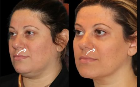 Real Patient Journey: Sculptra Fillers at the Best Aesthetic Clinic in Dubai