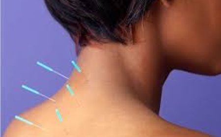 Things to Consider When Finding the Best Acupuncturist in Morristown
