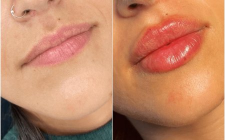 How to Choose the Best Plastic Surgeons in Dubai for Your Juvederm Treatment