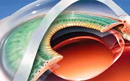 Vision Laser Surgery: A Clear Path to Better Sight