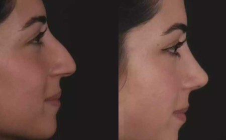 How Nose Deviated Septum Surgery in Dubai Works