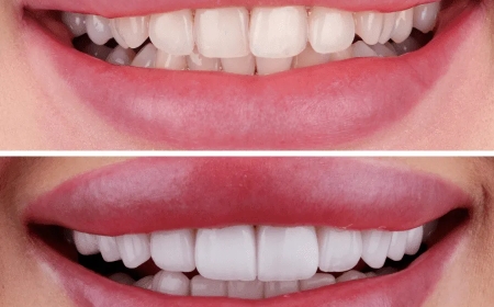 Transform Your Smile with Veneers Dubai: What You Should Know