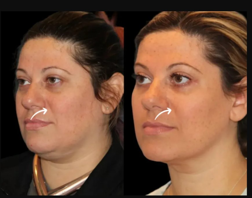Real Patient Journey: Sculptra Fillers at the Best Aesthetic Clinic in Dubai