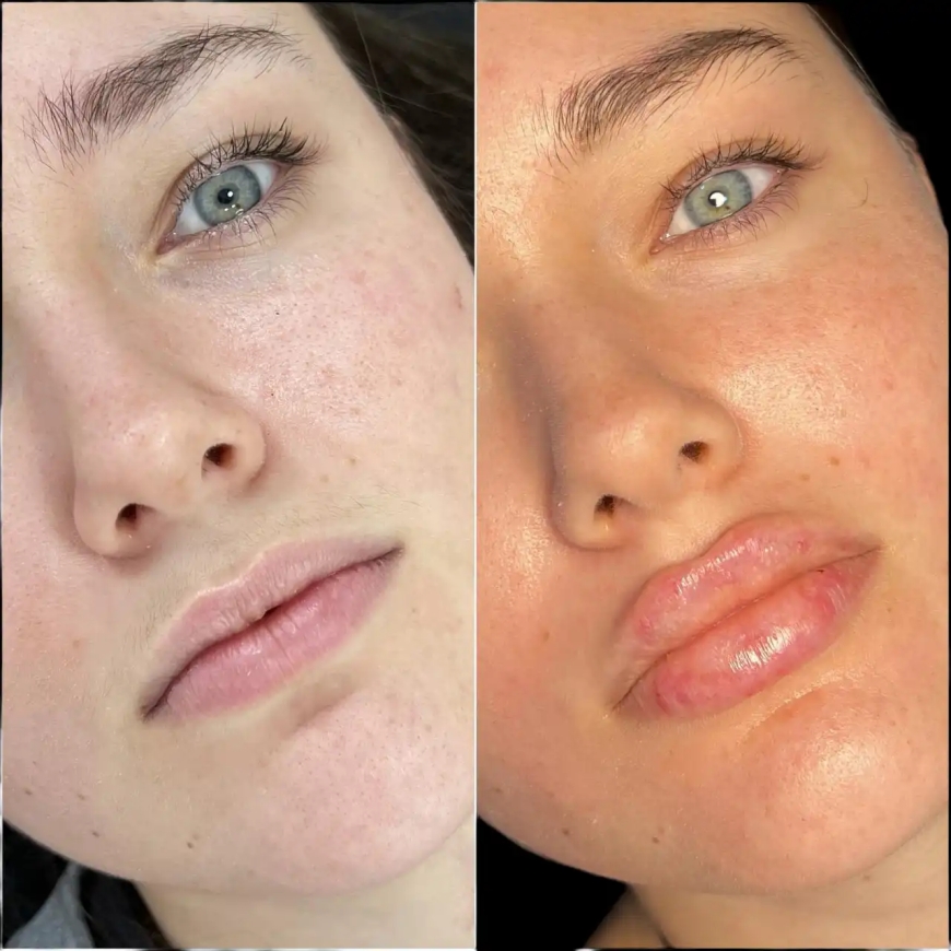Get Natural Results with the Best Plastic Surgeon in Dubai for Fillers