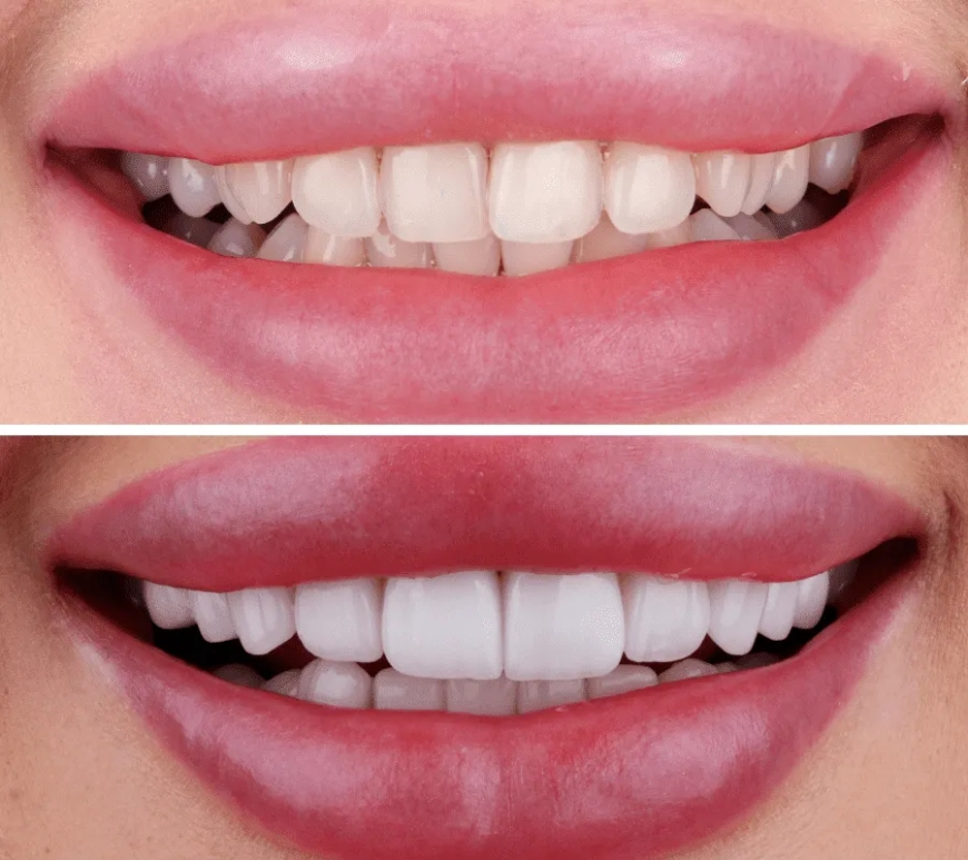 Transform Your Smile with Veneers Dubai: What You Should Know
