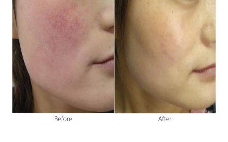 Your Guide to a Clearer Complexion with a Professional IPL Photofacial Near Spanish Fork