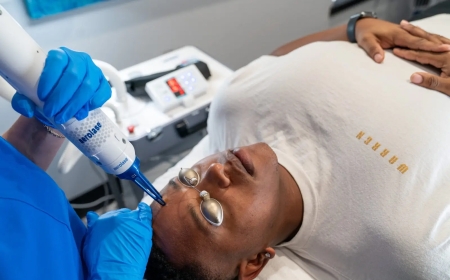 What Are the Benefits of Era Elite Laser Treatment for Sun Damage in Oshawa, Canada?