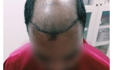 Finding the Best Hair Clinic in Coimbatore: A Guide to Hair Care and Restoration