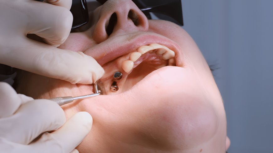 The Role Of Dental Implants In Preventing Bone Loss