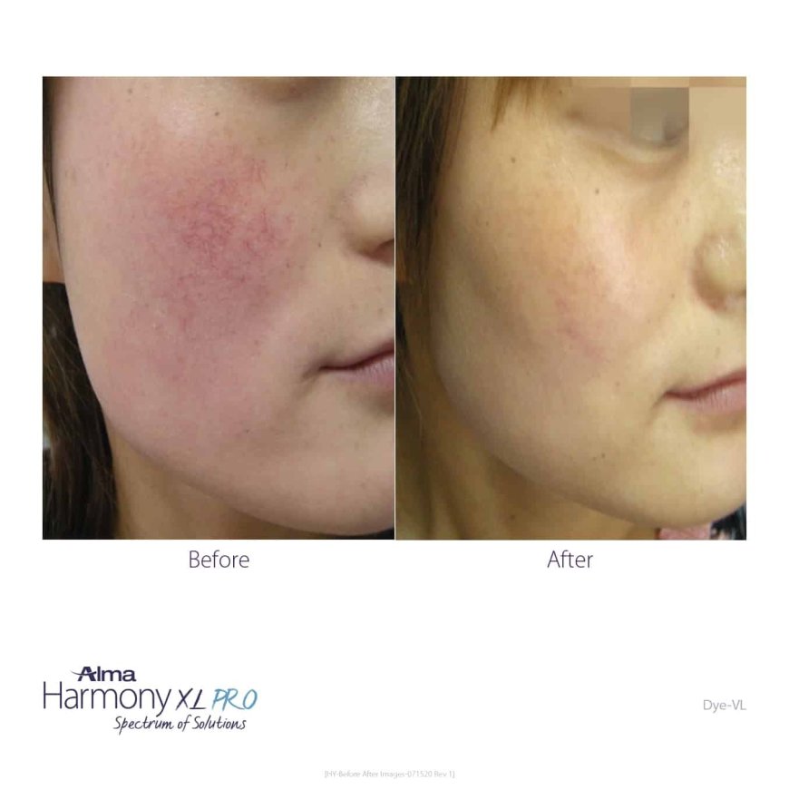 Your Guide to a Clearer Complexion with a Professional IPL Photofacial Near Spanish Fork