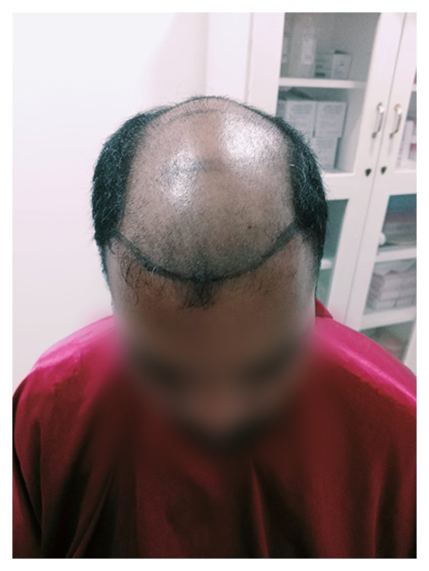 Finding the Best Hair Clinic in Coimbatore: A Guide to Hair Care and Restoration