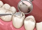 Best RCT Specialist in Floresville – Wilson Dental TX