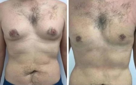 Understanding Incision Placement and Healing with the Best Gynecomastia Surgeon in Dubai