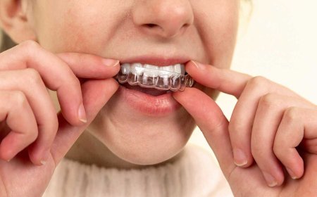 From Consultation to Completion: What to Expect with Invisalign