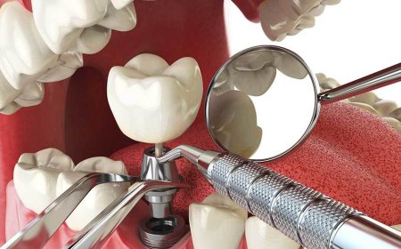 Dental Crowns – Restore Strength and a Beautiful Smile