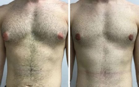 Gynecomastia in Dubai: How It Transforms Self-Image