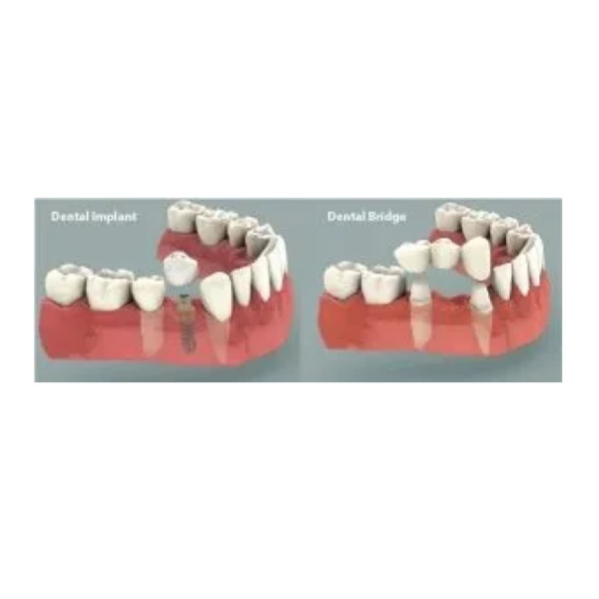 Looking for an Implant Dentist Near You? Here’s What You Need to Know