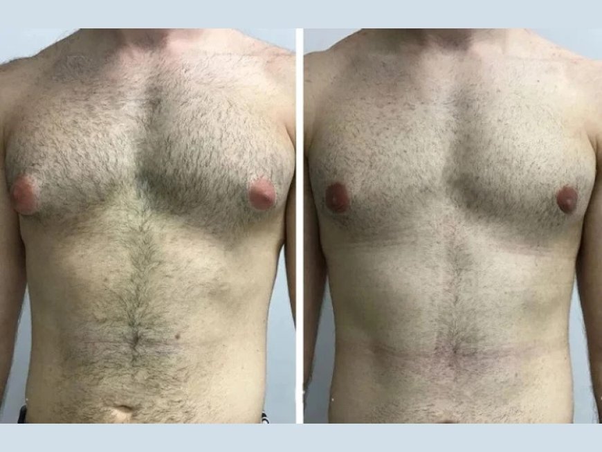Gynecomastia in Dubai: How It Transforms Self-Image