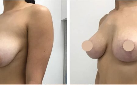 Language Support for International Breast Reduction Surgery in dubai Patients