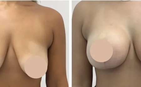 Breast Lift Surgery in dubai: Natural-Looking Results You’ll Love