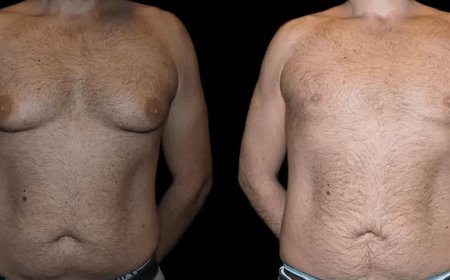 Gynecomastia Surgery in dubai: Feel Comfortable in Any Clothing