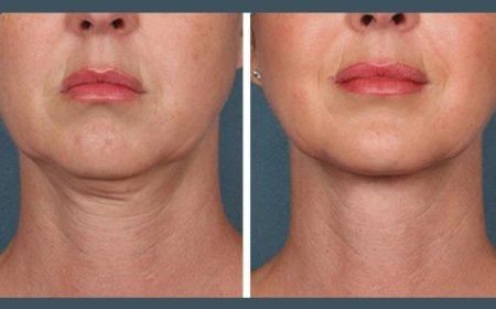 Best Doctors in dubai PRP Treatment for Facial Firmness