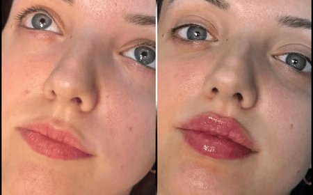 Best Plastic Surgeon in dubai for Quick Recovery Fillers