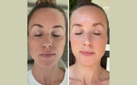 Instant Firmness and Glow with Fotona 4D Laser Treatments in Dubai