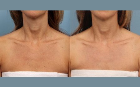 Get Ready for Red-Carpet Skin with Moxi Laser Treatments in Dubai