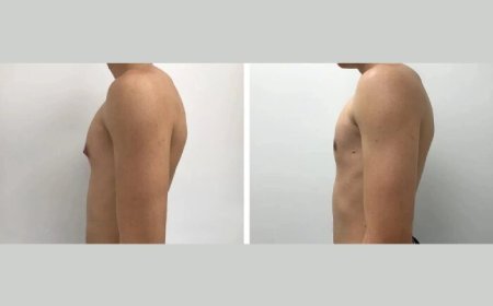 Gynecomastia Surgery in Dubai: Psychological Boost After Healing
