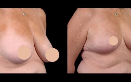 Implants and Breast Reduction in Dubai Hybrid Techniques