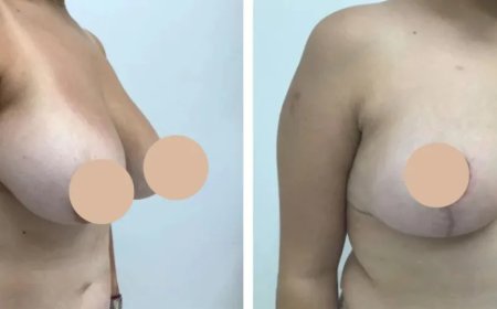 Breast Lift in Dubai Customized Treatments for Women