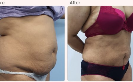 Liposuction Surgery Cost in Delhi - Dr Rajat Gupta