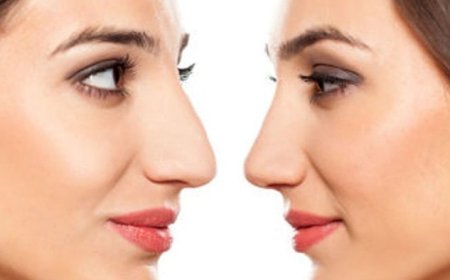 Expert Nasal Reshaping Procedures Available in Riyadh