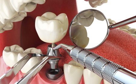 Are Dental Implants Covered by Insurance in Glendale? Here's What You Need to Know