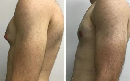 Gynecomastia Surgery in Dubai: Expert Advice for First-Time Patients