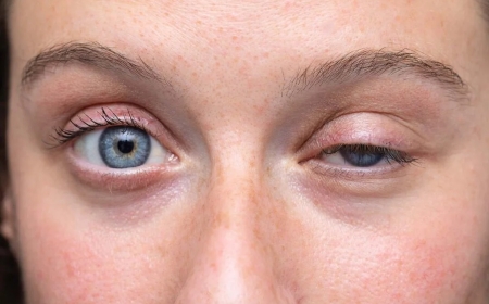 Eyelid Lift Cape Town: How Modern Techniques Deliver Natural Results 