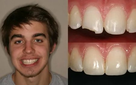 Discover The Magic Of Teeth Whitening In Rochdale For A Brighter Smile