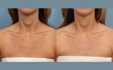 Flawless Confidence with Moxi Laser Treatment from the Best Plastic Surgeon in Dubai