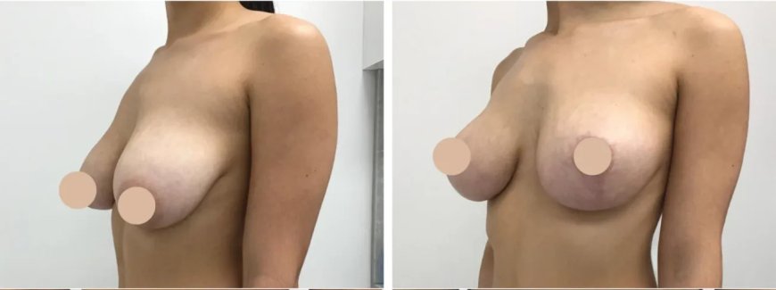 Language Support for International Breast Reduction Surgery in dubai Patients