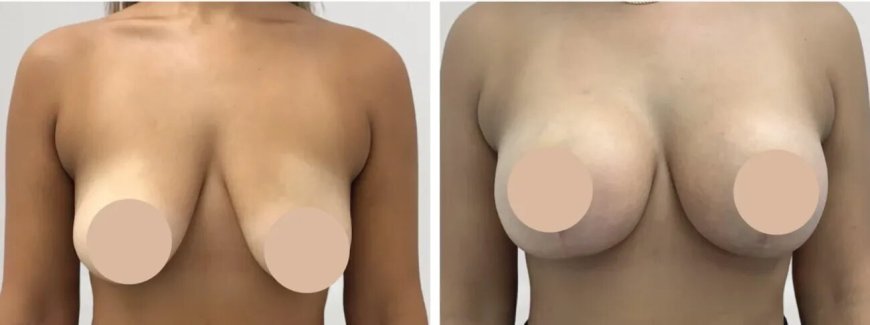 Breast Lift Surgery in dubai: Natural-Looking Results You’ll Love