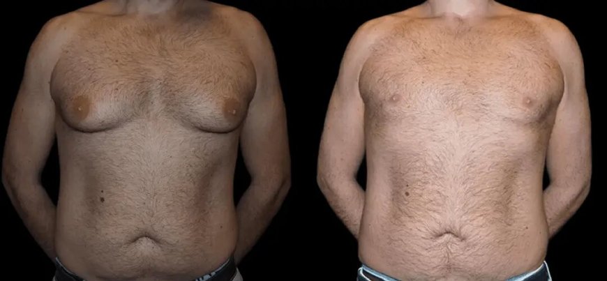 Gynecomastia Surgery in dubai: Feel Comfortable in Any Clothing
