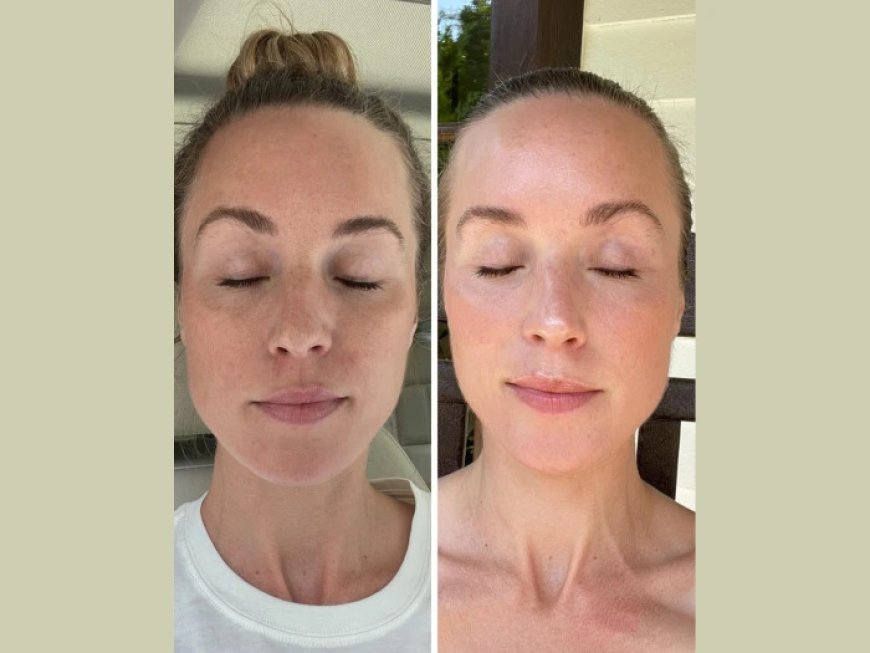 Instant Firmness and Glow with Fotona 4D Laser Treatments in Dubai